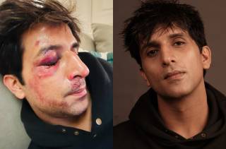 Arslan Goni slips on snow in Turkey, lands up with a bruised eye